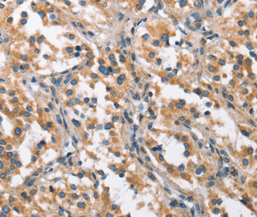 Иммуногистохимия, CHMP1A, ткань рака щитовидной железы человека