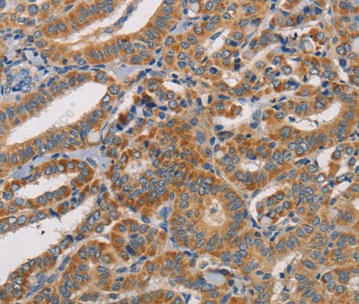 Иммуногистохимия, CDK11A/B, ткань рака щитовидной железы человека