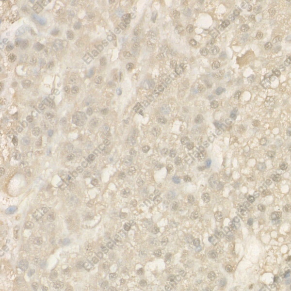 Иммуногистохимия, Cleaved Caspase-9 P37, ткань рака печени человека