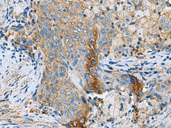 Иммуногистохимия, CLTB, ткань рака шейки матки человека