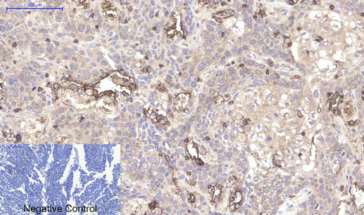 Иммуногистохимия, CD45, ткань рака легкого человека