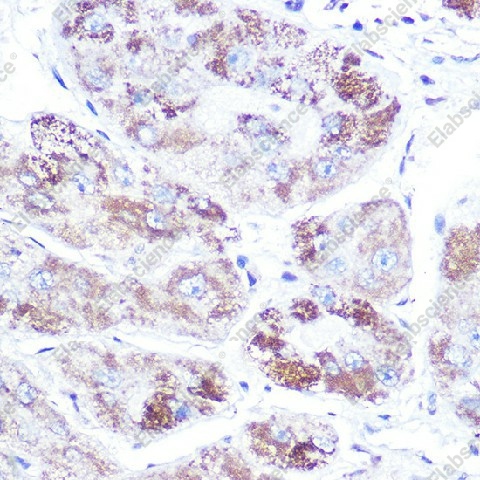 Иммуногистохимия, Mineralocorticoid receptor, ткань рака печени человека
