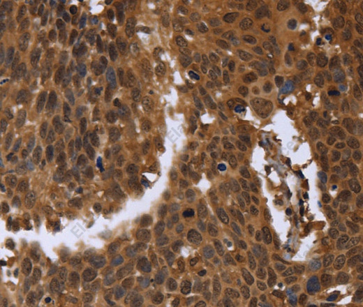 Иммуногистохимия, FGFRL1, ткань рака шейки матки человека