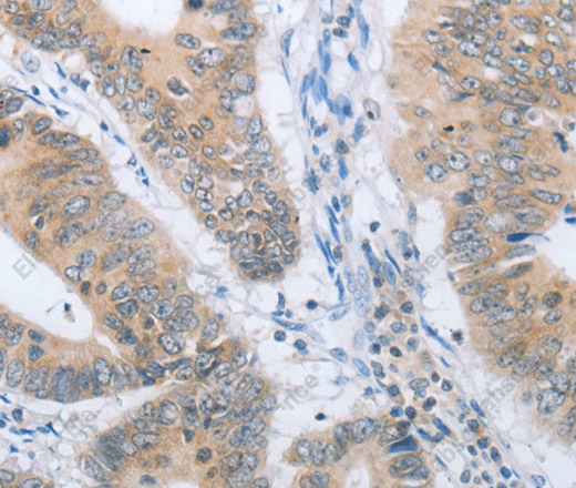Иммуногистохимия, CHRNA10, ткань рака толстой кишки человека