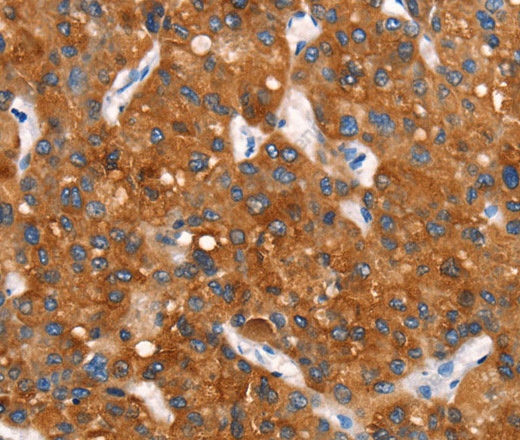 Иммуногистохимия, Cytochrome b, ткань рака печени человека