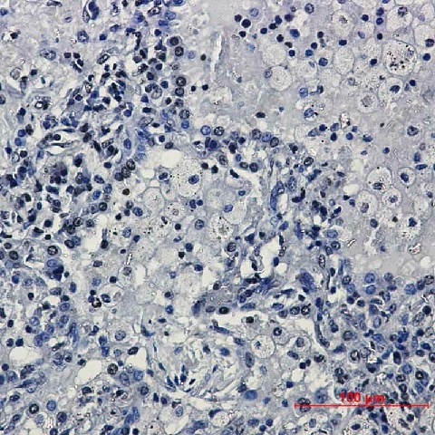 Иммуногистохимия, TriMethyl-Histone H3 (Lys27), ткань рака легкого человека