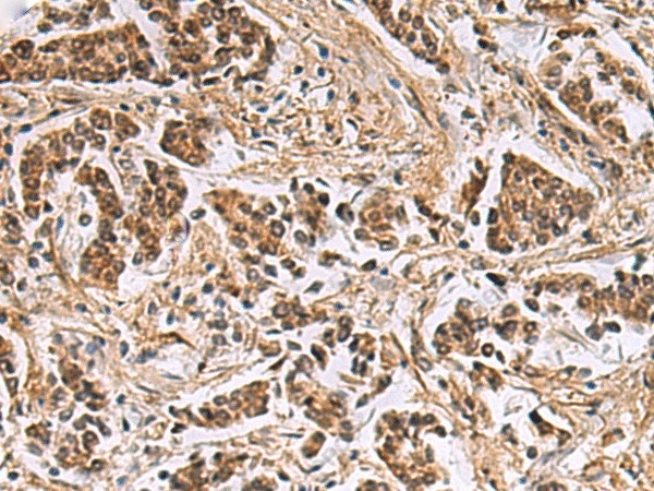 Иммуногистохимия, DNA2, ткань рака молочной железы человека