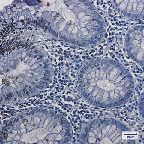Иммуногистохимия, Topoisomerase I, ткань рака толстой кишки человека