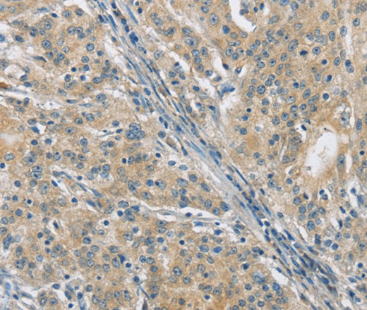 Иммуногистохимия, PKD1, ткань рака желудка человека