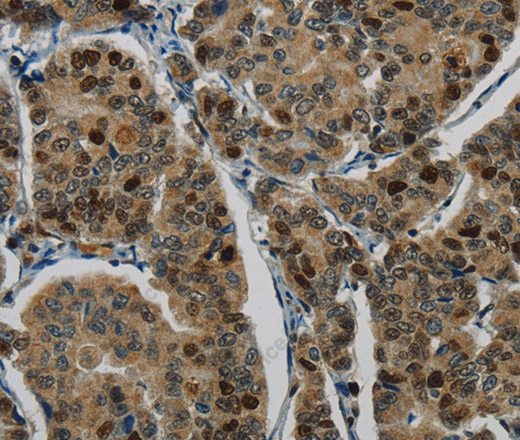 Иммуногистохимия, DNA Ligase1, ткань рака молочной железы человека