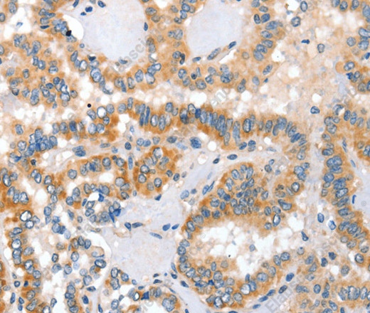 Иммуногистохимия, Placental Alkaline Phosphatase, ткань рака щитовидной железы человека