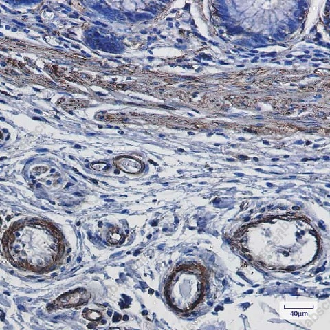 Иммуногистохимия, alpha smooth muscle Actin, ткань рака толстой кишки человека