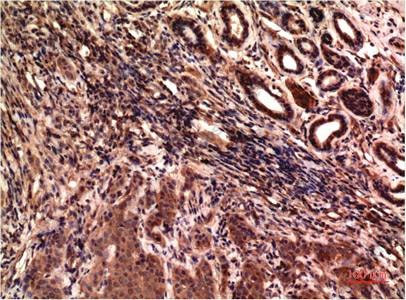 Иммуногистохимия, gamma Tubulin, ткань карциномы молочной железы человека