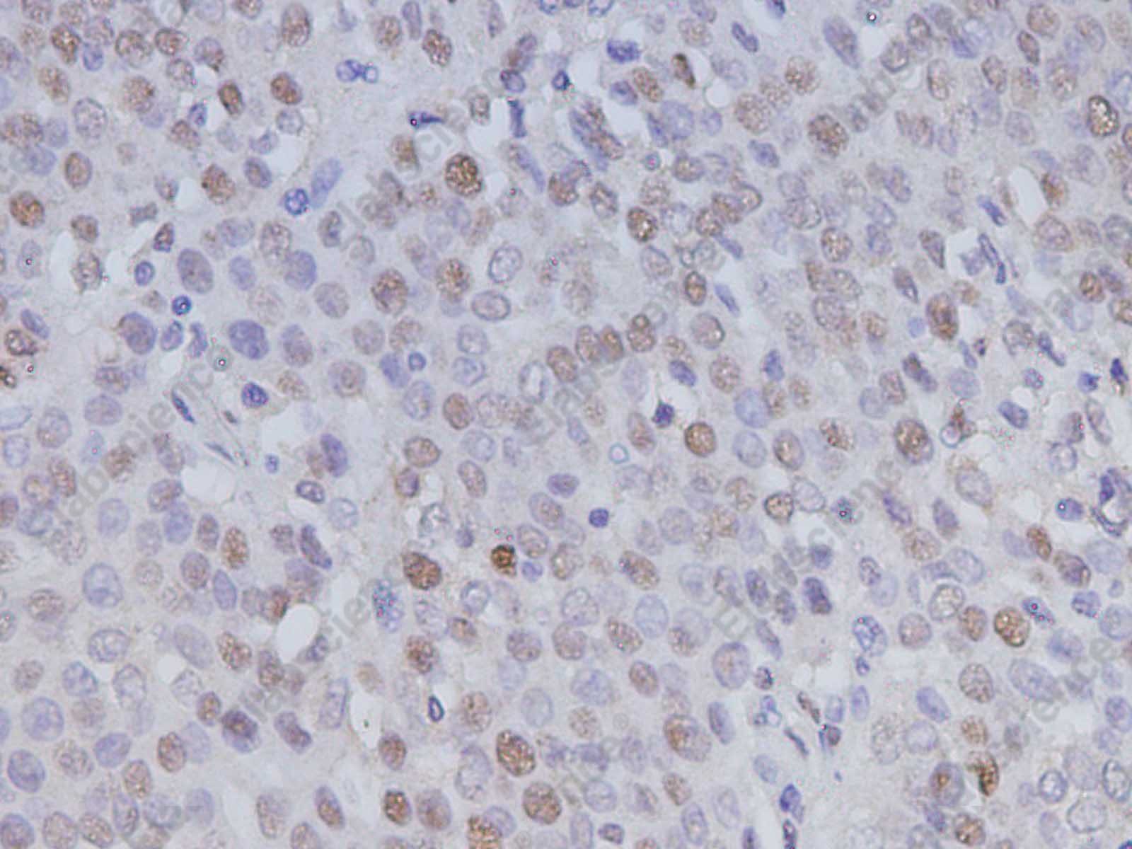Иммуногистохимия, PCNA, ткань рака легкого человека
