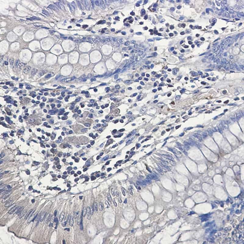 Иммуногистохимия, Ubiquitin (K63), ткань рака толстой кишки человека