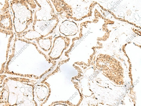 Иммуногистохимия, RPP14, ткань рака щитовидной железы человека