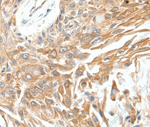 Иммуногистохимия, SCN11A, ткань рака молочной железы человека