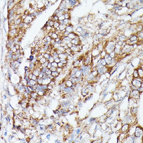 Иммуногистохимия, NUBP1, карцинома толстой кишки человека