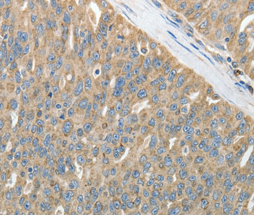 Иммуногистохимия, HSP90B1, ткань рака яичника человека