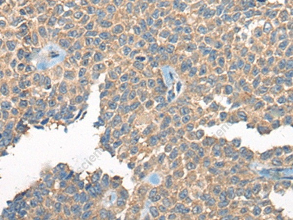 Иммуногистохимия, PPP3R1, ткань рака яичника человека
