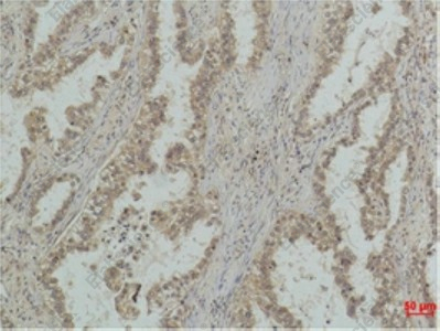 Иммуногистохимия, P53 (Mono Methyl Lys370), ткань карциномы легкого человека